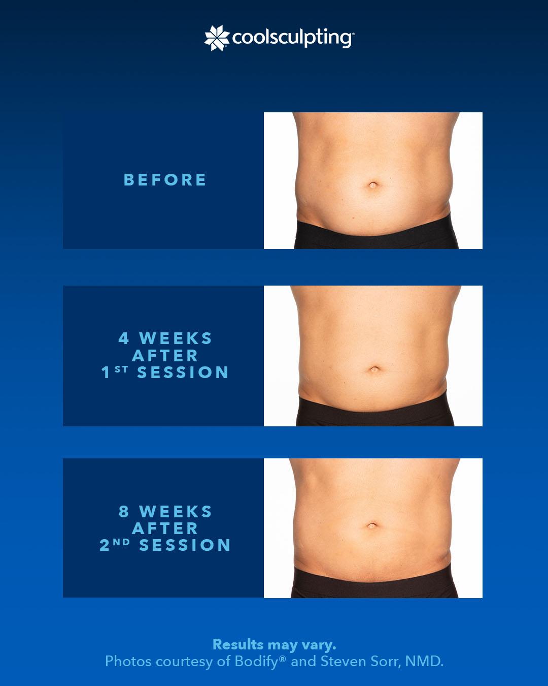 Body Coolsculpting Certification Virtual Beauty Institute Body Coolsculpting Certification Virtual Beauty Institute