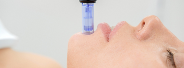 Why You Should Use Microneedling For Acne Scars