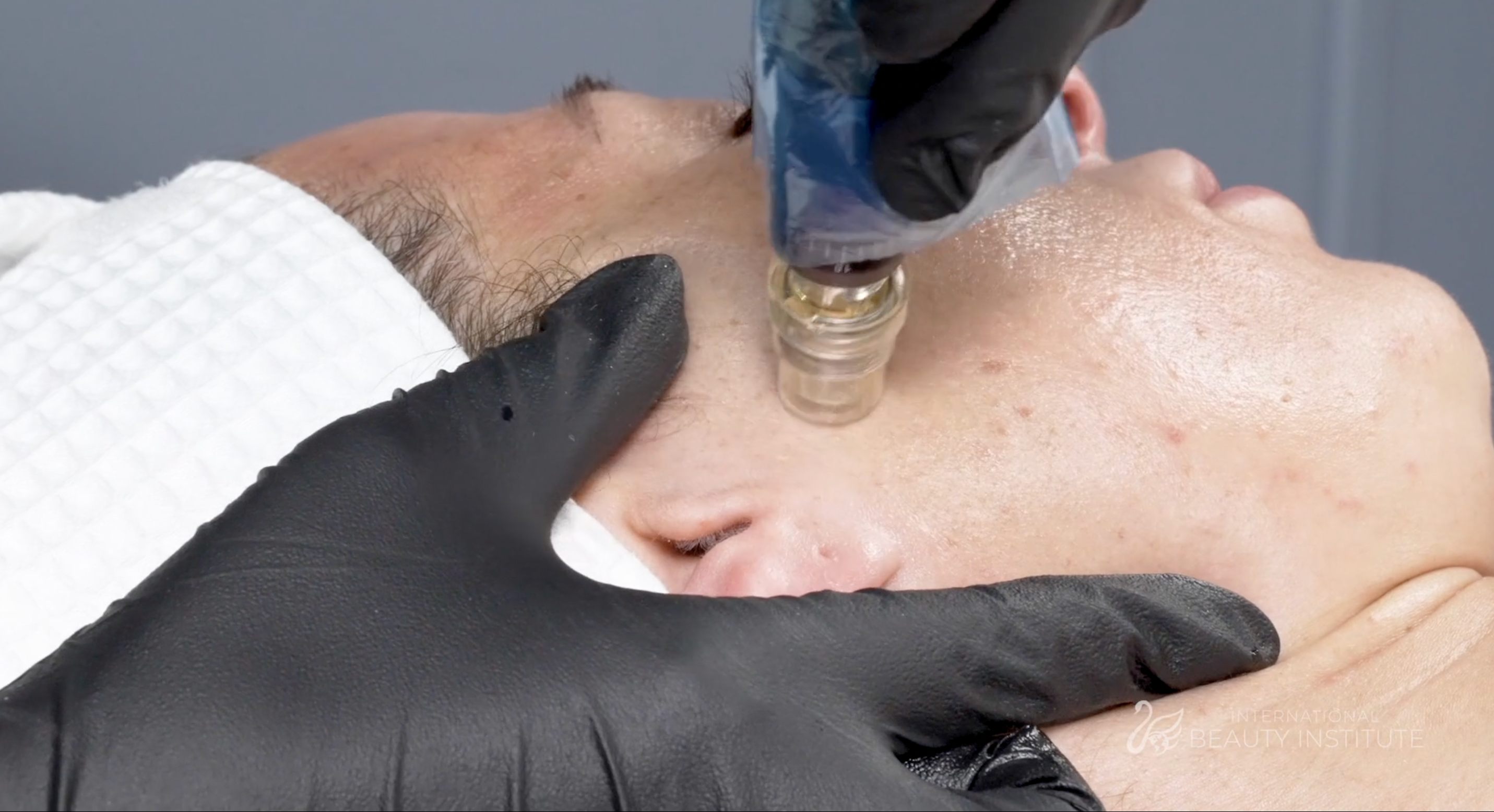 microneedling being performed on a woman's cheek