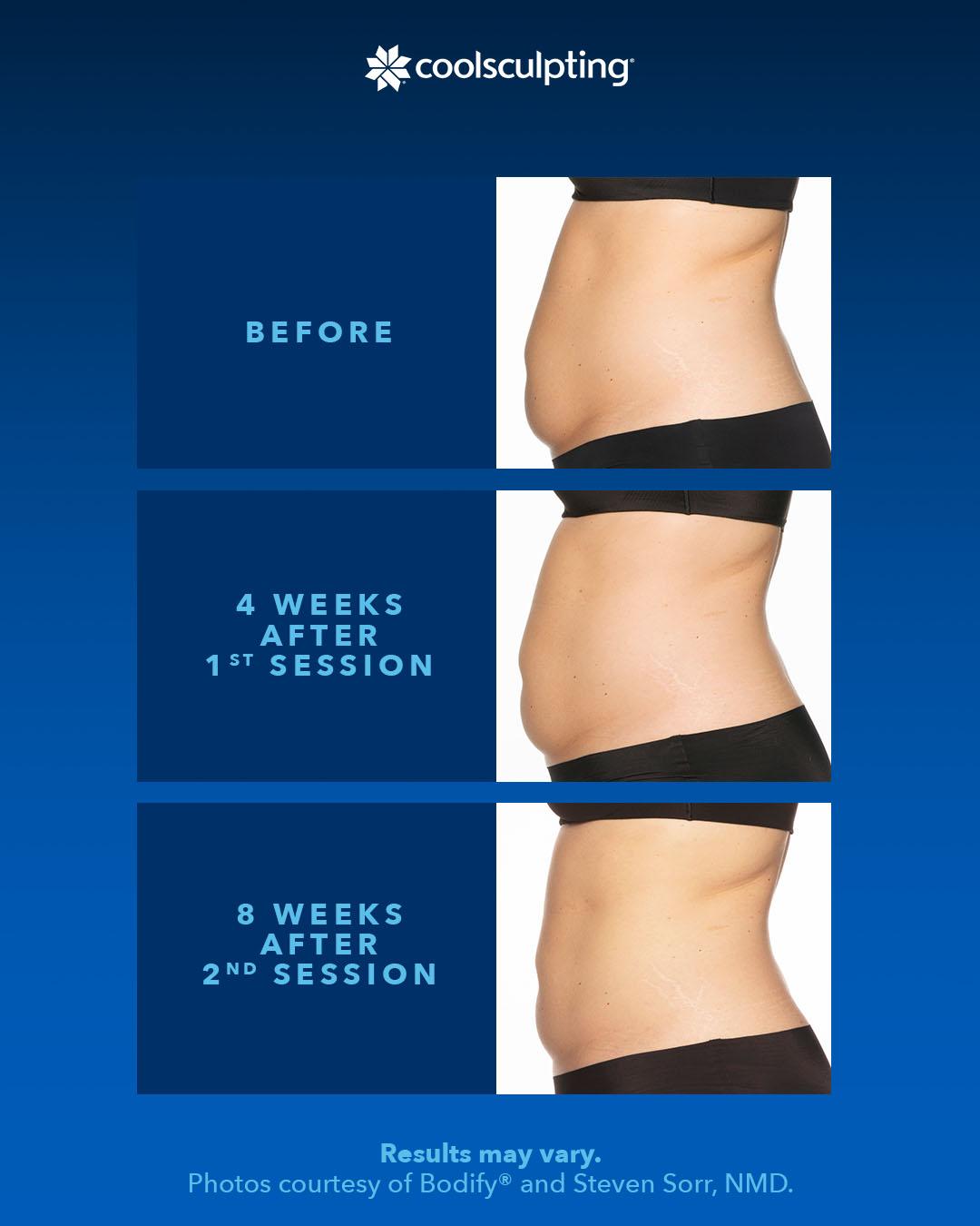before and after comparison of coolsculpting a stomach