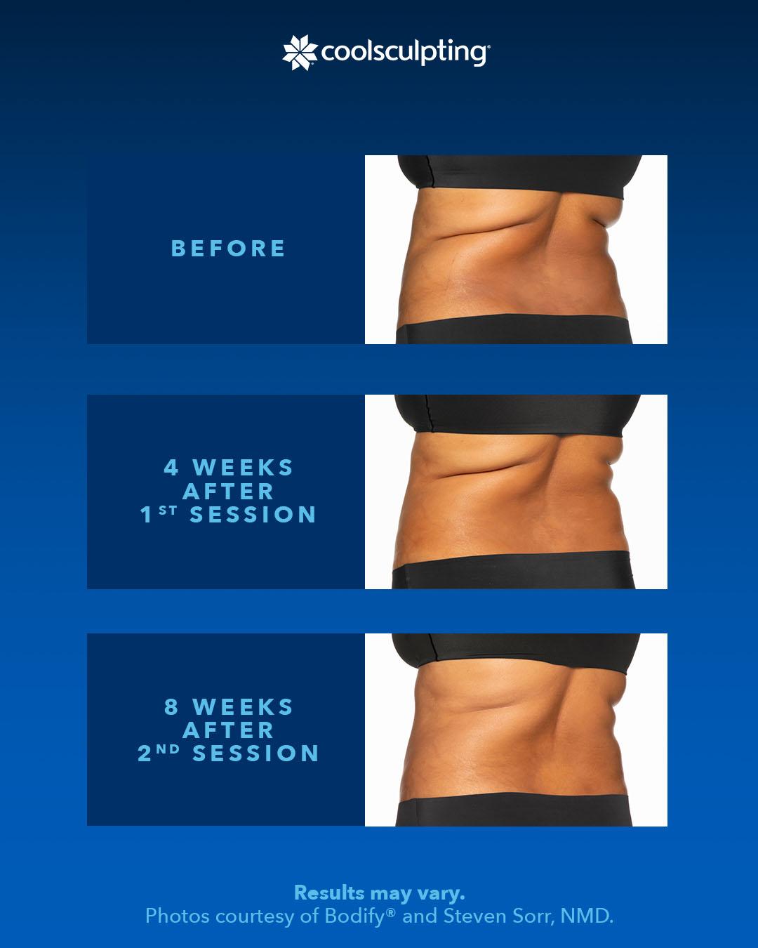 before and after comparison of coolsculpting a back