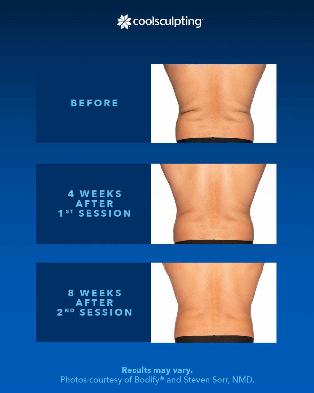 before and after comparison of coolsculpting a back